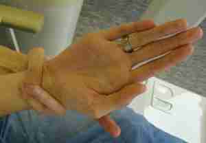 sindrome di marfan malattia cause e trattamento